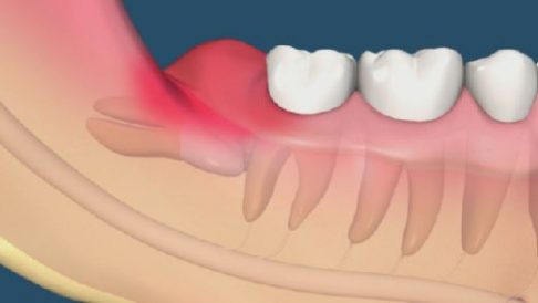 Περιστεφανίτιδα Φρονιμήτη – Χειρουργική Στόματος Π.Μπόσνα