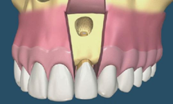 Ακρορριζεκτομή – Χειρουργείο Στόματος – Π.Μπόσνα, Αριδαία