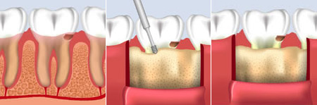 Επιμήκυνση Μύλης – Οδοντίατρος Π.Μπόσνα, Αριδαία