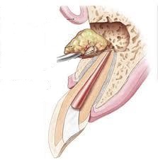 Ακρορριζεκτομή – Χειρουργείο Στόματος – Π.Μπόσνα, Αριδαία