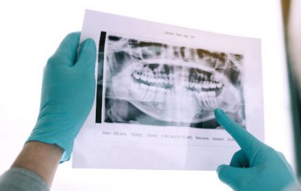 Πανοραμική Ακτινογραφία στο οδοντιατρείο της Π. Μπόσνα